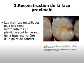 3.Reconstruction de la face proximale Les matrices métalliques plus des coins interdentaires en plastique sont le garant de la futur étanchéité d’un point de contact  2 .  Mise en place d’un champ opératoire à l’aide d’une matrice métallique et d’un coin plastique afin d’assurer l’herméticité cervicale. 