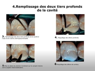 4.Remplissage des deux tiers profonds de la cavité 3.  Remplissage des deux tiers profonds de la cavité à l’aide d’une résine chémopolymérisable 4.  Maquillage des sillons profonds. 5 .Mise en place du premier incrément sur le versant interne de la cuspide mésiovestibulaire. 6 .Maquillage des sillons de surface. 