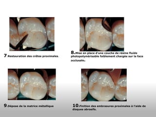 7 . Restauration des crêtes proximales . 8. Mise en place d’une couche de résine fluide photopolymérisable faiblement chargée sur la face occlusale . 9 .Dépose de la matrice métallique 10 .Finition des embrasures proximales à l’aide de disques abrasifs. 