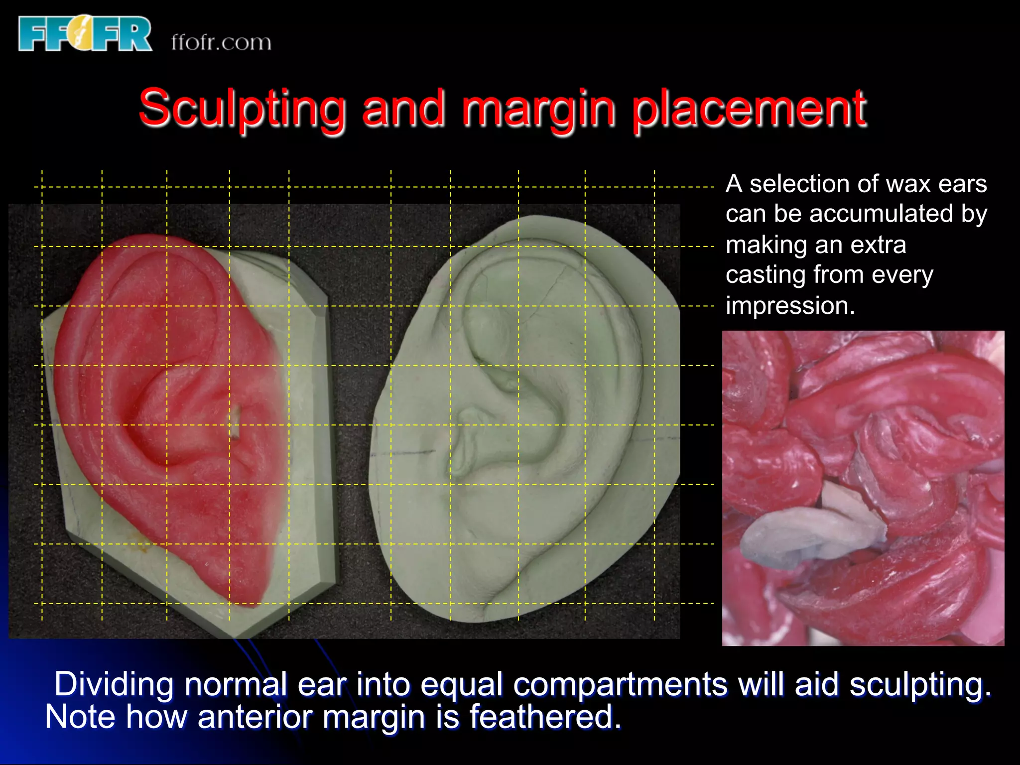 Restoration of ear defects | PDF