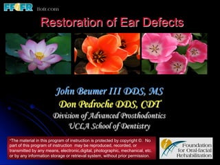 Restoration of Ear Defects




                        John Beumer III DDS, MS
                         Don Pedroche DDS, CDT
                       Division of Advanced Prosthodontics
                            UCLA School of Dentistry
*The material in this program of instruction is protected by copyright ©. No
part of this program of instruction may be reproduced, recorded, or
transmitted by any means, electronic,digital, photographic, mechanical, etc.
or by any information storage or retrieval system, without prior permission.
 