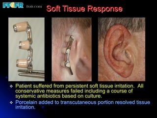 Restoration of ear defects | PDF
