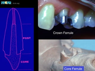 Restoration of endodontically treated teeth | PDF