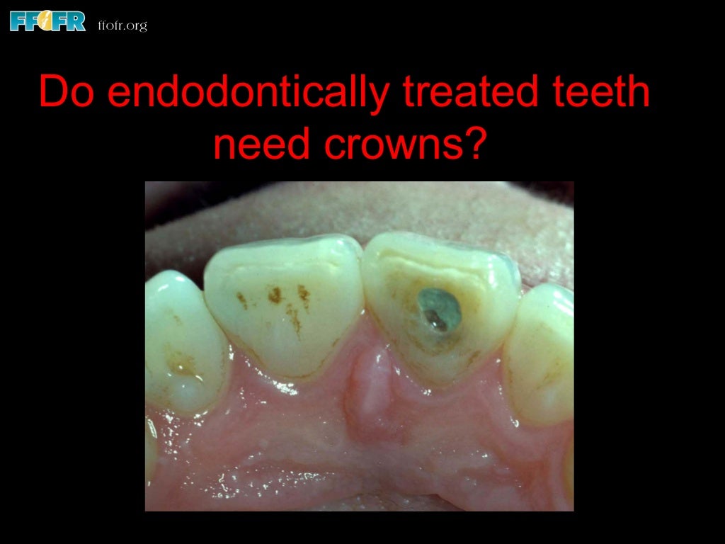 Restoration of endodontically treated teeth