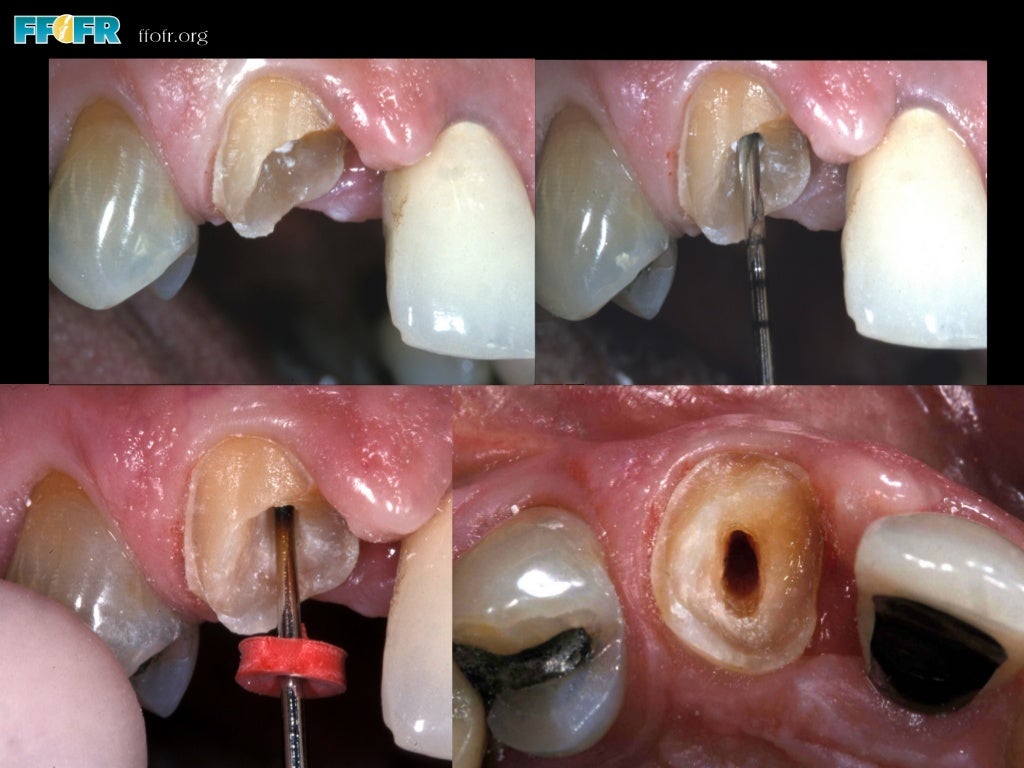 Restoration of endodontically treated teeth