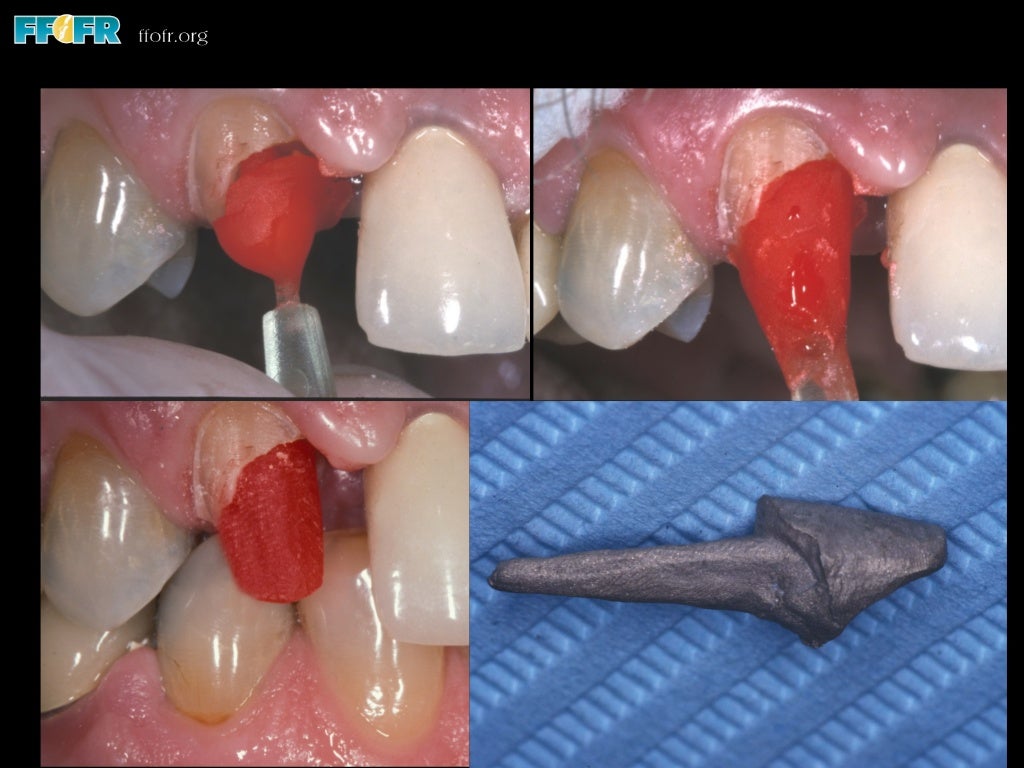Restoration of endodontically treated teeth