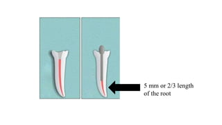 Restoration of endodontically treated teeth | PDF
