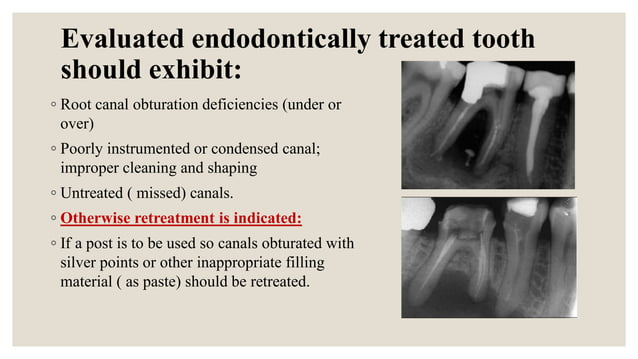 Restoration of endodontically treated teeth | PDF