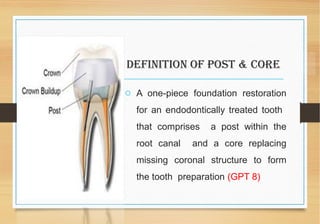 Restoration of endodontically treated teeth | PPT