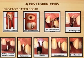 Restoration of endodontically treated teeth | PPT