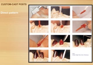 Post Indirect Kit Restoration of endodontically treated teeth | PPT