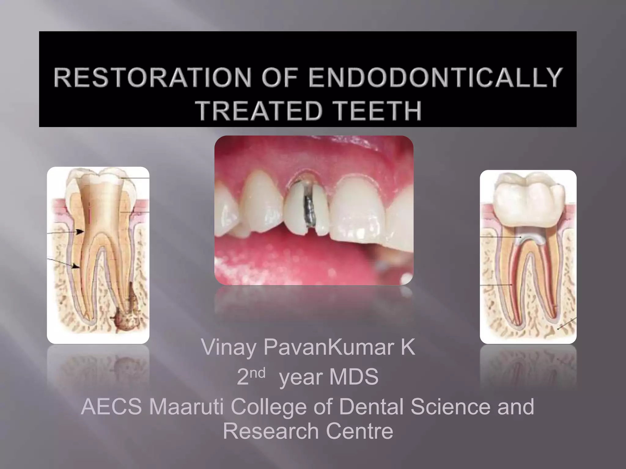 Prosthetic restoration of endodontically treated tooth | PPTX