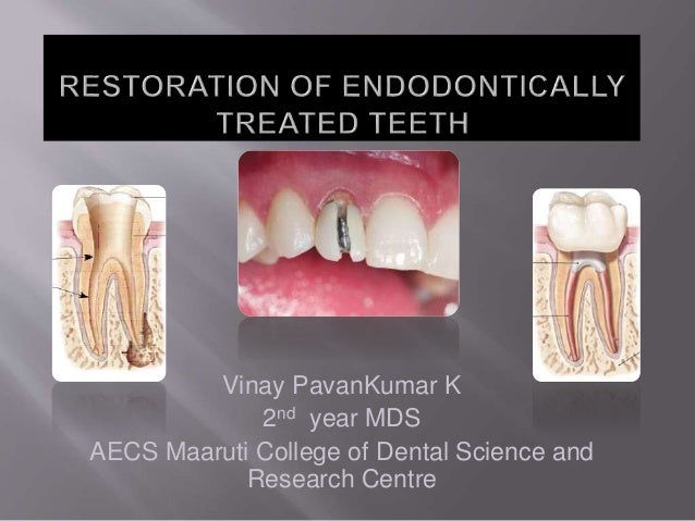 Prosthetic Restoration Of Endodontically Treated Tooth - 