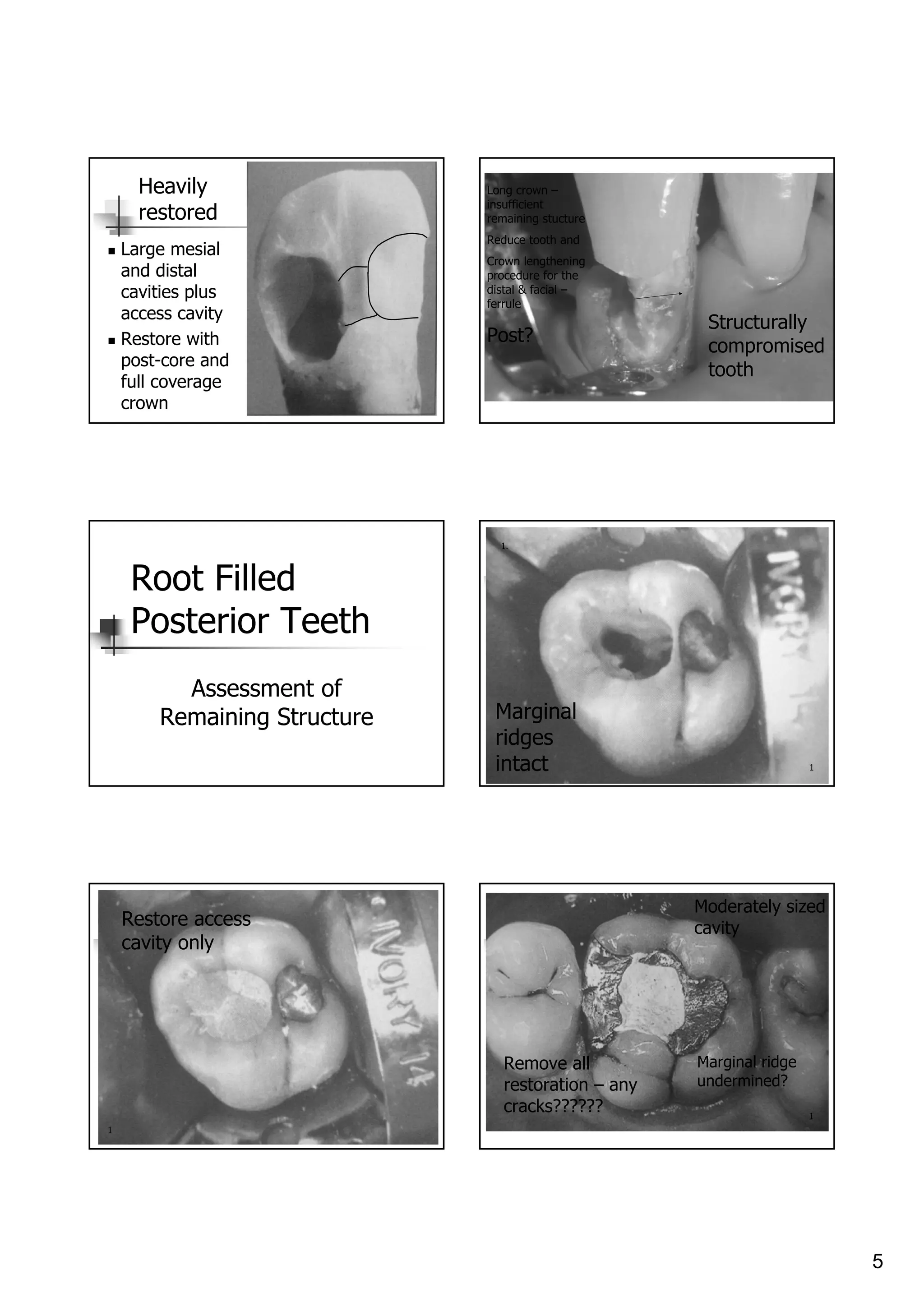 Restoration of enododontically treated teeth | PDF