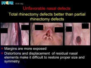Rt3 Defect Restoration of facial defects basic priniciples | PPT