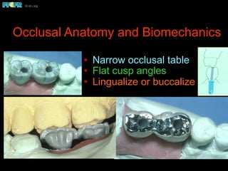Occlusal Anatomy and Biomechanics
•  Narrow occlusal table
•  Flat cusp angles
•  Lingualize or buccalize
 