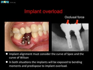 Implant overload
l  Implant	
  alignment	
  must	
  consider	
  the	
  curve	
  of	
  Spee	
  and	
  the	
  
curve	
  of	
  Wilson	
  
l  In	
  both	
  situa(ons	
  the	
  implants	
  will	
  be	
  exposed	
  to	
  bending	
  
moments	
  and	
  predispose	
  to	
  implant	
  overload.	
  
Occlusal force
 