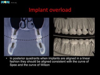 Implant	
  overload	
  
•  In posterior quadrants when implants are aligned in a linear
fashion they should be aligned consistent with the curve of
Spee and the curve of Wilson
Curve of Wilson
 