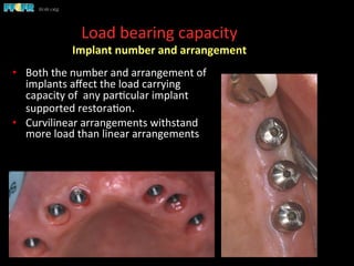 Load	
  bearing	
  capacity	
  
Implant	
  number	
  and	
  arrangement	
  
•  Both	
  the	
  number	
  and	
  arrangement	
  of	
  
implants	
  aﬀect	
  the	
  load	
  carrying	
  
capacity	
  of	
  	
  any	
  par(cular	
  implant	
  
supported	
  restora(on.	
  	
  	
  
•  Curvilinear	
  arrangements	
  withstand	
  
more	
  load	
  than	
  linear	
  arrangements	
  
 