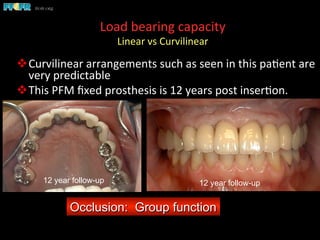 Load	
  bearing	
  capacity	
  
Linear	
  vs	
  Curvilinear	
  
	
  
v Curvilinear	
  arrangements	
  such	
  as	
  seen	
  in	
  this	
  pa(ent	
  are	
  
very	
  predictable	
  
v This	
  PFM	
  ﬁxed	
  prosthesis	
  is	
  12	
  years	
  post	
  inser(on.	
  
Occlusion: Group function
12 year follow-up12 year follow-up
 