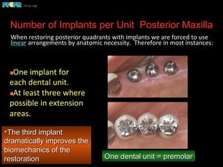 Number of Implants per Unit Posterior Maxilla
	
  When	
  restoring	
  posterior	
  quadrants	
  with	
  implants	
  we	
  are	
  forced	
  to	
  use	
  
linear	
  arrangements	
  by	
  anatomic	
  necessity.	
  	
  Therefore	
  in	
  most	
  instances:	
  
	
  
*The third implant
dramatically improves the
biomechanics of the
restoration
 One	
  implant	
  for	
  
each	
  dental	
  unit.	
  
 At	
  least	
  three	
  where	
  
possible	
  in	
  extension	
  
areas.	
  
One dental unit = premolar
 