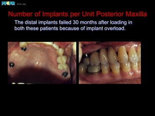 Number of Implants per Unit Posterior Maxilla
The distal implants failed 30 months after loading in
both these patients because of implant overload.
 