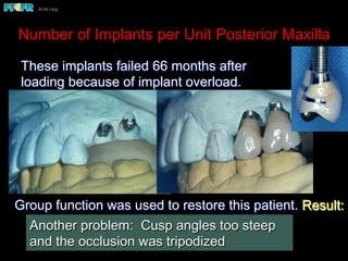 Number of Implants per Unit Posterior Maxilla
These implants failed 66 months after
loading because of implant overload.
Group function was used to restore this patient. Result:
 Application of excessive lateral forces
 Implant failure
Another problem: Cusp angles too steep
and the occlusion was tripodized
 