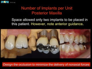 Number of Implants per Unit
Posterior Maxilla
Space allowed only two implants to be placed in
this patient. However, note anterior guidance.
Design the occlusion to minimize the delivery of nonaxial forces
 