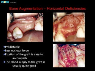 Bone Augmentation – Horizontal Deficiencies
 Predictable	
  
 Less	
  occlusal	
  force	
  
 Fixa(on	
  of	
  the	
  grae	
  is	
  easy	
  to	
  
	
  accomplish	
  
 The	
  blood	
  supply	
  to	
  the	
  grae	
  is	
  
	
  usually	
  quite	
  good	
  	
  	
  	
  
 