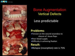 Bone Augmentation
Vertical Defects
Less	
  predictable	
  
Problems:	
  
 Tension	
  on	
  the	
  wound	
  secondary	
  to	
  
	
  closure	
  of	
  	
  (ssue	
  ﬂaps	
  
 Poor	
  blood	
  supply	
  
 Diﬃculty	
  in	
  achieving	
  ﬁxa(on	
  
Result:	
  
 Relapse	
  (resorp(on)	
  rate	
  is	
  75%	
  
 
