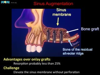 Sinus Augmentation
Advantages	
  over	
  onlay	
  gra7s	
  
	
  Resorp(on	
  probably	
  less	
  than	
  25%	
  
Challenge	
  
	
  Elevate	
  the	
  sinus	
  membrane	
  without	
  perfora(on	
  
Sinus
membrane
Bone graft
Bone of the residual
allveolar ridge
 