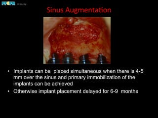 Sinus	
  Augmenta(on	
  
•  Implants can be placed simultaneous when there is 4-5
mm over the sinus and primary immobilization of the
implants can be achieved
•  Otherwise implant placement delayed for 6-9 months
 