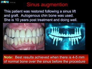 Sinus augmention
This patient was restored following a sinus lift
and graft. Autogenous chin bone was used.
She is 10 years post treatment and doing well.
Note: Best results achieved when there is 4-5 mm
of normal bone over the sinus before the procedure
 