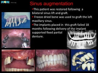 Sinus augmentation
§ This	
  pa(ent	
  was	
  restored	
  following	
  	
  a	
  	
  	
  	
  	
  	
  
bilateral	
  sinus	
  lie	
  and	
  grae.	
  	
  
§ 	
  Freeze	
  dried	
  bone	
  was	
  used	
  to	
  grae	
  the	
  lee	
  
maxillary	
  sinus.	
  	
  	
  
§ The	
  implants	
  placed	
  in	
  	
  this	
  grae	
  failed	
  18	
  
months	
  following	
  delivery	
  of	
  the	
  implant	
  
supported	
  ﬁxed	
  par(al	
  	
  
denture.	
  
 