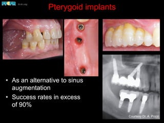 Pterygoid implants
•  As an alternative to sinus
augmentation
•  Success rates in excess
of 90%
Courtesy Dr. A. Pozzi
 