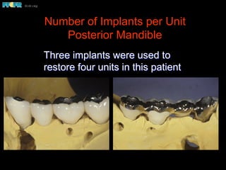 Number of Implants per Unit
Posterior Mandible
Three implants were used to
restore four units in this patient
 