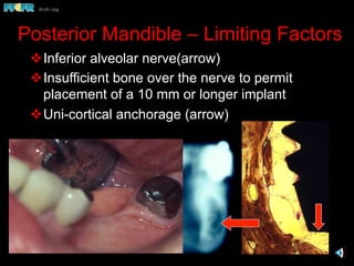 Posterior Mandible – Limiting Factors
v Inferior alveolar nerve(arrow)
v Insufficient bone over the nerve to permit
placement of a 10 mm or longer implant
v Uni-cortical anchorage (arrow)
 