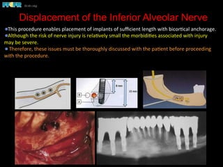 Displacement of the Inferior Alveolar Nerve
 This	
  procedure	
  enables	
  placement	
  of	
  implants	
  of	
  suﬃcient	
  length	
  with	
  bicor(cal	
  anchorage.	
  	
  
 Although	
  the	
  risk	
  of	
  nerve	
  injury	
  is	
  rela(vely	
  small	
  the	
  morbidi(es	
  associated	
  with	
  injury	
  
may	
  be	
  severe.	
  	
  
 	
  Therefore,	
  these	
  issues	
  must	
  be	
  thoroughly	
  discussed	
  with	
  the	
  pa(ent	
  before	
  proceeding	
  
with	
  the	
  procedure.	
  
 