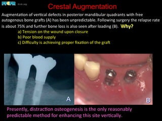 Crestal Augmentation
Augmenta(on	
  of	
  ver(cal	
  defects	
  in	
  posterior	
  mandibular	
  quadrants	
  with	
  free	
  
autogenous	
  bone	
  graes	
  (A)	
  has	
  been	
  unpredictable.	
  Following	
  surgery	
  the	
  relapse	
  rate	
  
is	
  about	
  75%	
  and	
  further	
  bone	
  loss	
  is	
  also	
  seen	
  aeer	
  loading	
  (B).	
  	
  Why?	
  
	
  a)	
  Tension	
  on	
  the	
  wound	
  upon	
  closure	
  
	
  b)	
  Poor	
  blood	
  supply	
  	
  
	
  c)	
  Diﬃculty	
  is	
  achieving	
  proper	
  ﬁxa(on	
  of	
  the	
  grae	
  	
  
BA
Presently,	
  distrac(on	
  osteogenesis	
  is	
  the	
  only	
  reasonably	
  
predictable	
  method	
  for	
  enhancing	
  this	
  site	
  ver(cally.	
  	
  
 