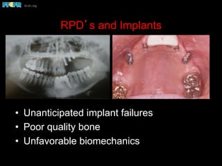 RPD’s and Implants
•  Unanticipated implant failures
•  Poor quality bone
•  Unfavorable biomechanics
 