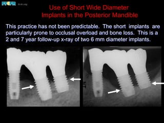 Use of Short Wide Diameter
Implants in the Posterior Mandible
This practice has not been predictable. The short implants are
particularly prone to occlusal overload and bone loss. This is a
2 and 7 year follow-up x-ray of two 6 mm diameter implants.
 