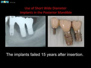 Use	
  of	
  Short	
  Wide	
  Diameter	
  
	
  Implants	
  in	
  the	
  Posterior	
  Mandible	
  
The implants failed 15 years after insertion.
 