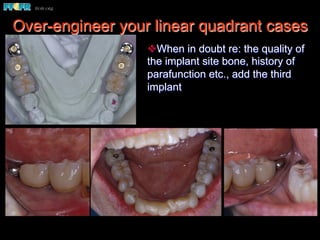 Over-engineer your linear quadrant cases
v When in doubt re: the quality of
the implant site bone, history of
parafunction etc., add the third
implant
 