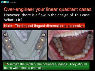 Over-engineer your linear quadrant cases
v Minimize the width of the occlusal surfaces. They should
be no wider than a premolar
Note: The buccal-lingual dimension is excessive
However,	
  there	
  is	
  a	
  ﬂaw	
  in	
  the	
  design	
  of	
  	
  this	
  case.	
  	
  
What	
  is	
  it?	
  
 