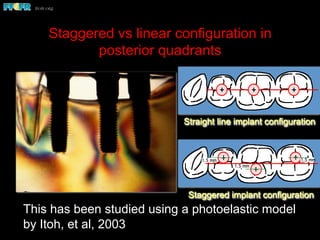 Staggered vs linear configuration in
posterior quadrants
This has been studied using a photoelastic model
by Itoh, et al, 2003
Staggered implant configuration
1.5 mm
1.5 mm 1.5 mm
Straight line implant configuration
 