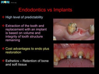 Endodontics vs Implants
v High level of predictability
v Extraction of the tooth and
replacement with an implant
is based on volume and
integrity of tooth structure
remaining
v Cost advantages to endo plus
restoration
v Esthetics – Retention of bone
and soft tissue
 