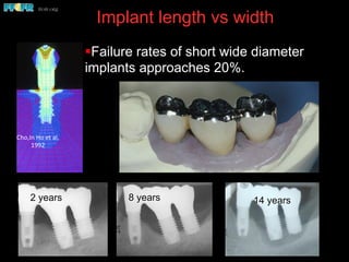 Implant length vs width
§ Failure rates of short wide diameter
implants approaches 20%.
2 years 8 years
Cho,In	
  Ho	
  et	
  al,	
  
1992	
  
14 years
 