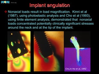 v Nonaxial loads result in load magnification. Kinni et al
(1987), using photoelastic analysis and Cho et al (1993),
using finite element analysis, demonstrated that nonaxial
loads concentrated potentially clinically significant stresses
around the neck and at the tip of the implant.
Implant angulation
Cho,In	
  Ho	
  et	
  al,	
  1992	
  
 