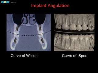 Curve of Wilson
Implant	
  Angula(on	
  	
  
Curve of Wilson Curve of Spee
 
