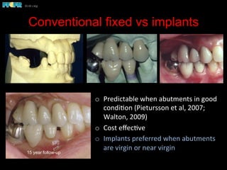 Conventional fixed vs implants
o  Predictable	
  when	
  abutments	
  in	
  good	
  
condi(on	
  (Pietursson	
  et	
  al,	
  2007;	
  
Walton,	
  2009)	
  
o  Cost	
  eﬀec(ve	
  
o  Implants	
  preferred	
  when	
  abutments	
  
are	
  virgin	
  or	
  near	
  virgin	
  
	
  
15 year follow-up
 